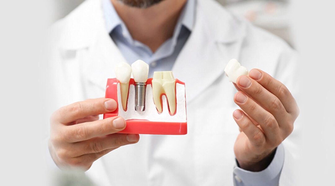 How to Extend the Life of Your Dental Implants