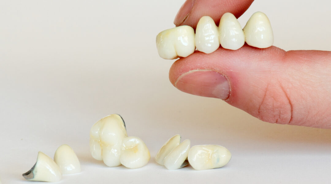 The Pros And Cons of Dental Crowns