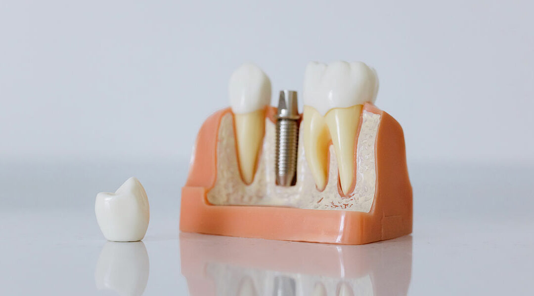 Are You a Candidate for Dental Implants? A Comprehensive Guide to Assessing