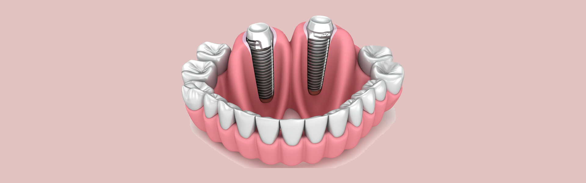 Unlock Your Best Smile: Top Benefits of Dental Implants in Norcross